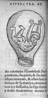 An illustration from Des divers travaulx et enfantemens des femmes. Et par quel moyen lon doibt survenir aux accidens qui peuvent eschoir devant et apres iceux travaulx, devisé en deux petiz livres. Premierement composez en Latin, par maistre Euchaire Rodion, Docteur en Medecine, et depuis tournez en nostre langue Françoyse, et augmentez de Annotations, par M. Paul Bienassis de Poictiers, à l’utilité de plusieurs personnes. Avec Indice des choses memorables contenues en ce present livre, mises par chapitres en la fin d’icelluy (1563)