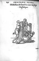 An illustration from Chirurgie françoise, recueillie par M. Jaques Dalechamps, Docteur Medicin, et Lecteur ordinaire de ceste profession à Lyon. Avec plusieurs figures des instrumens necessaires pour l’operation manuelle. La page 14. contient les principaux chefz de ce qui se discourt en cest œuvre, (1569)