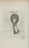Picture 24 of 25 from Le chemin frayé et infaillible aux accouchemens, qui servira de flambeau aux sages-femmes, pour les éclairer en leurs operations, cachées dans les plus obscures cavernes de la matrice. Le tout enrichi de diverses figures... (1689), leaf 109