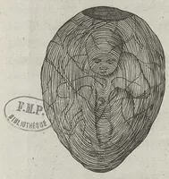 Picture 4 of 25 from Le chemin frayé et infaillible aux accouchemens, qui servira de flambeau aux sages-femmes, pour les éclairer en leurs operations, cachées dans les plus obscures cavernes de la matrice. Le tout enrichi de diverses figures... (1689), leaf 18