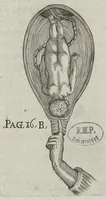 Picture 6 of 25 from Le chemin frayé et infaillible aux accouchemens, qui servira de flambeau aux sages-femmes, pour les éclairer en leurs operations, cachées dans les plus obscures cavernes de la matrice. Le tout enrichi de diverses figures... (1689), leaf 34