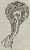 An illustration from Le chemin frayé et infaillible aux accouchemens, qui servira de flambeau aux sages-femmes, pour les éclairer en leurs operations, cachées dans les plus obscures cavernes de la matrice. Le tout enrichi de diverses figures... (1689)