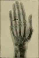 An illustration from The ABC of the X rays (1896)