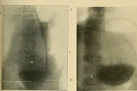Picture 26 of 62 from The alimentary tract : a radiographic study (1915), leaf 108