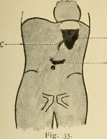An illustration from The alimentary tract : a radiographic study (1915)
