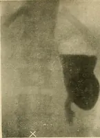 An illustration from The alimentary tract : a radiographic study (1915)