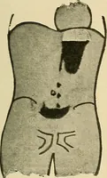 An illustration from The alimentary tract : a radiographic study (1915)