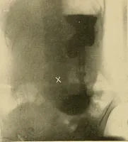 An illustration from The alimentary tract : a radiographic study (1915)