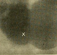 Picture 34 of 62 from The alimentary tract : a radiographic study (1915), leaf 122