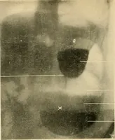 Picture 35 of 62 from The alimentary tract : a radiographic study (1915), leaf 125