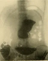 An illustration from The alimentary tract : a radiographic study (1915)