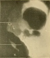 An illustration from The alimentary tract : a radiographic study (1915)