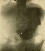 An illustration from The alimentary tract : a radiographic study (1915)