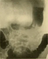 An illustration from The alimentary tract : a radiographic study (1915)