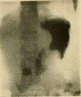 An illustration from The alimentary tract : a radiographic study (1915)