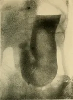 An illustration from The alimentary tract : a radiographic study (1915)