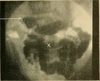 Picture 45 of 62 from The alimentary tract : a radiographic study (1915), leaf 156