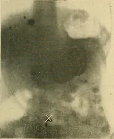 An illustration from The alimentary tract : a radiographic study (1915)