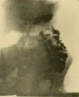 Picture 48 of 62 from The alimentary tract : a radiographic study (1915), leaf 156