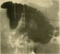 An illustration from The alimentary tract : a radiographic study (1915)