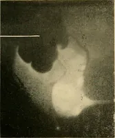 Picture 51 of 62 from The alimentary tract : a radiographic study (1915), leaf 192