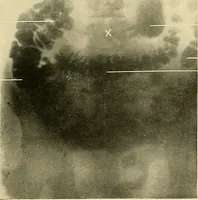 An illustration from The alimentary tract : a radiographic study (1915)