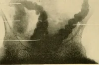 Picture 58 of 62 from The alimentary tract : a radiographic study (1915), leaf 201