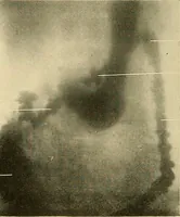 Picture 59 of 62 from The alimentary tract : a radiographic study (1915), leaf 201