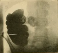 Picture 62 of 62 from The alimentary tract : a radiographic study (1915), leaf 209