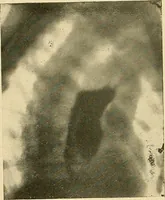 An illustration from The alimentary tract : a radiographic study (1915)