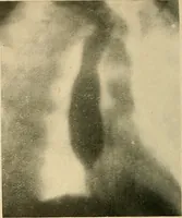 Picture 8 of 62 from The alimentary tract : a radiographic study (1915), leaf 53