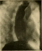 An illustration from The alimentary tract : a radiographic study (1915)