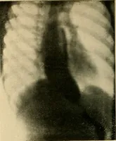 Picture 10 of 62 from The alimentary tract : a radiographic study (1915), leaf 59