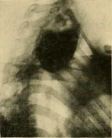 Picture 11 of 62 from The alimentary tract : a radiographic study (1915), leaf 59