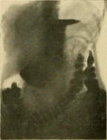 An illustration from The alimentary tract : a radiographic study (1915)