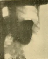 An illustration from The alimentary tract : a radiographic study (1915)