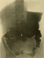 An illustration from The alimentary tract : a radiographic study (1915)