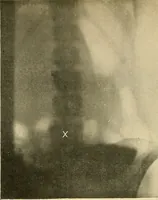 An illustration from The alimentary tract : a radiographic study (1915)