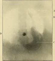 An illustration from The alimentary tract : a radiographic study (1915)