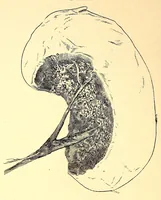 An illustration from The American journal of the medical sciences (1827)
