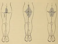 An illustration from The American journal of the medical sciences (1827)