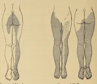 An illustration from The American journal of the medical sciences (1827)