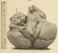 An illustration from The American journal of the medical sciences (1827)