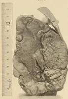 An illustration from The American journal of the medical sciences (1827)