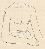 An illustration from The American journal of the medical sciences (1827)
