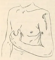 An illustration from The American journal of the medical sciences (1827)