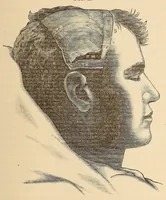 An illustration from The American journal of the medical sciences (1827)