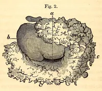 An illustration from The American journal of the medical sciences (1827)