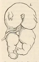 An illustration from The American journal of the medical sciences (1827)