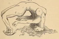 Picture 9 of 18 from The American journal of the medical sciences (1827), leaf 393